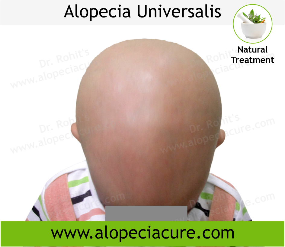 Primary Alopecia Areata